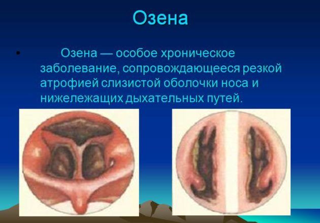 Озена носа