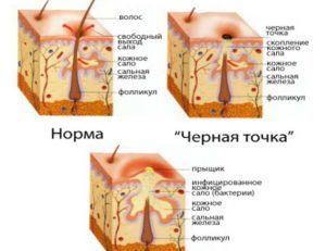 Как образовываются фурункулы