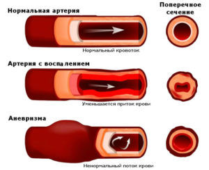 Нарушение кровообращения может вызвать онемение