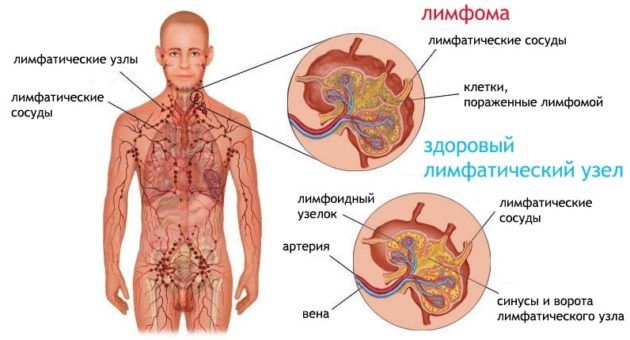 Лимфома