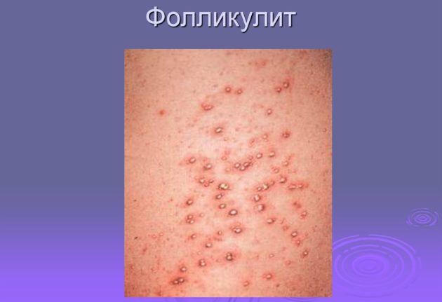 Фолликулит