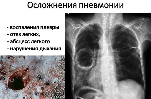 Пневмония бактериального происхождения