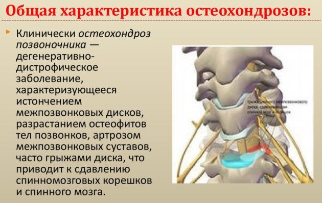 Остеохондроз