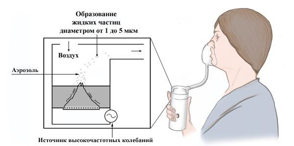 Применение небулайзера