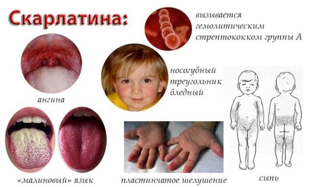 Скарлатина