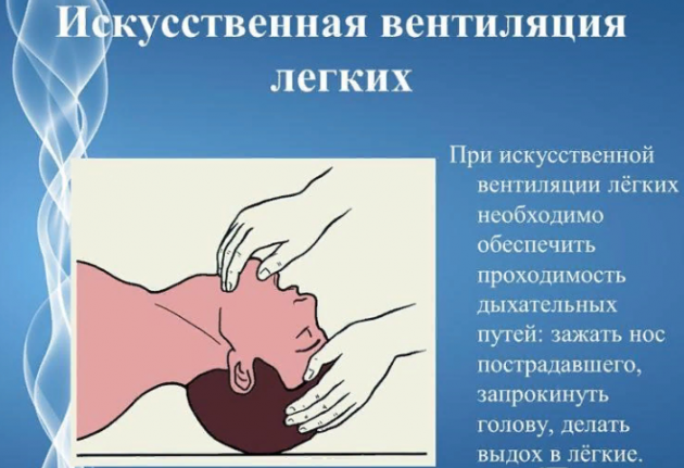 Искусственная вентиляция легких