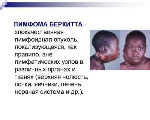 Лимфому Беркитта