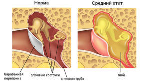 Отит среднего уха