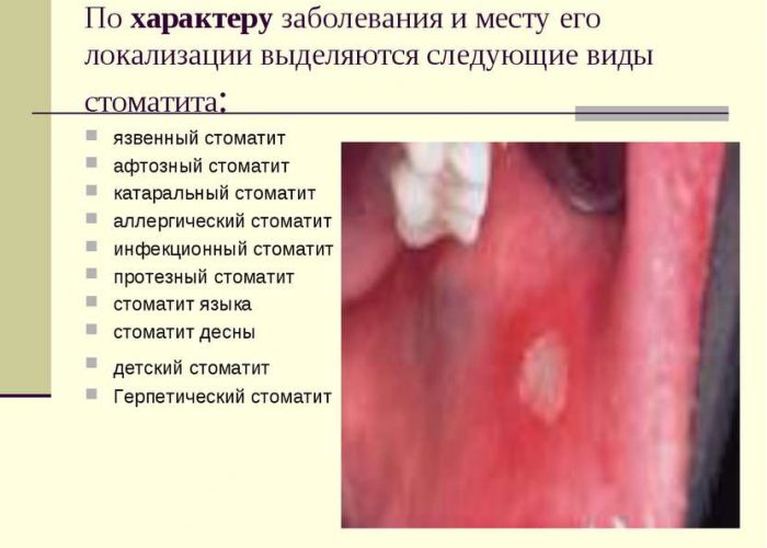Стоматит Стоматит