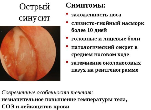 Синусит