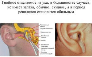 Выделения из уха при гнойном отите