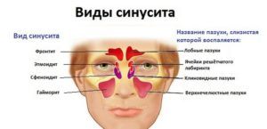 Виды синусита