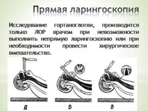 Прямая ларингоскопия