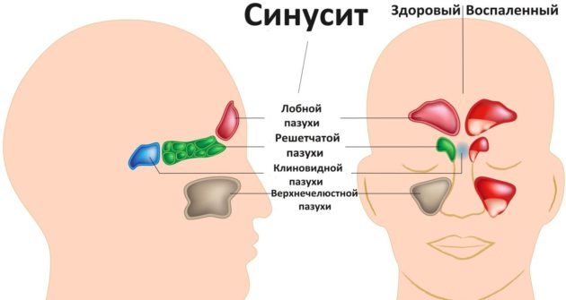 Синусит