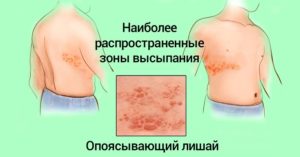 Опоясывающий лишай
