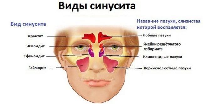 Синусит