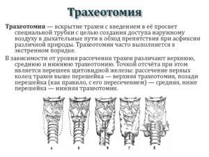Трахеотомия при параличе глотки