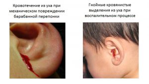 При поврежденной перепонки, использование фурацилинового раствора, строго запрещено