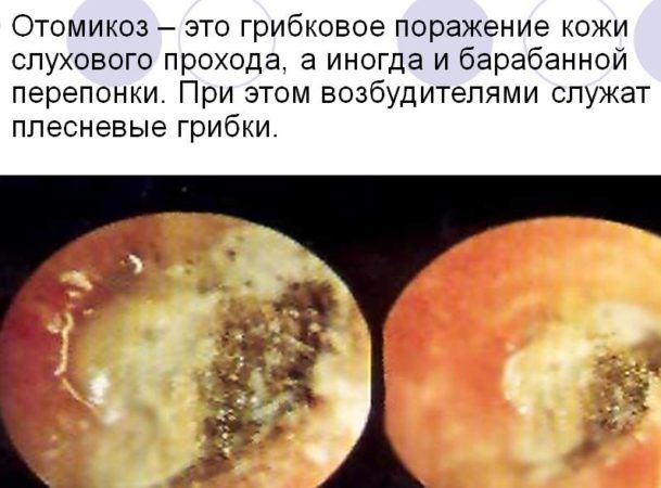 Грибковый отит