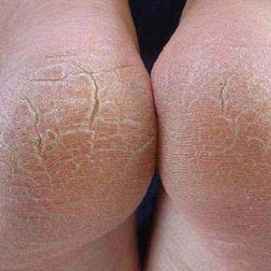 Удаление натоптышей на пятках: обзор эффективных методов