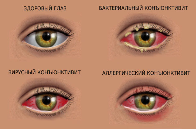 Конъюнктивит