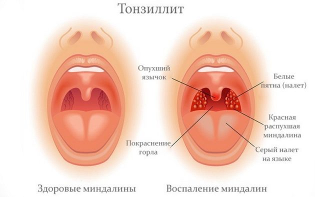 Тонзиллит