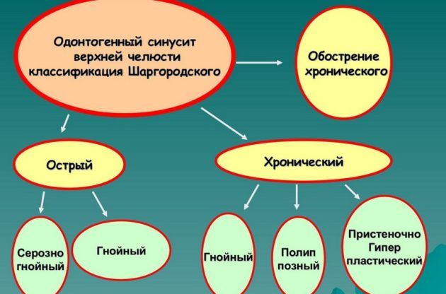 Одонтогенный синусит