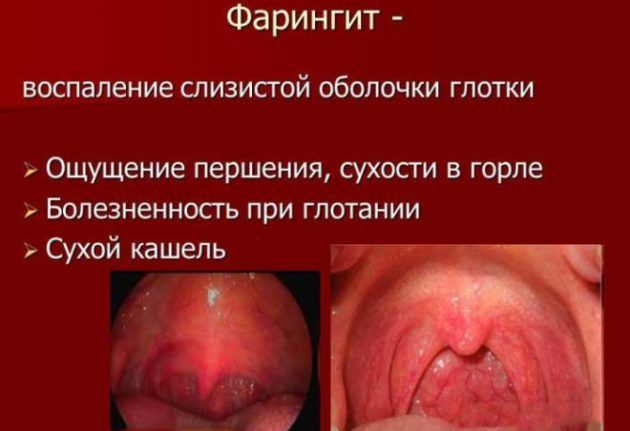 Фарингит