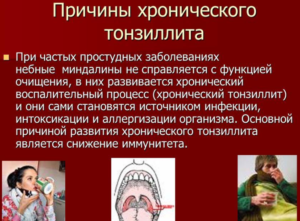 Причины хронического тонзиллита