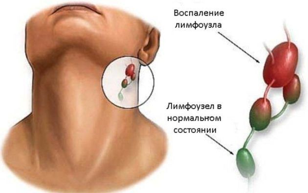 Воспаления лимфоузлов