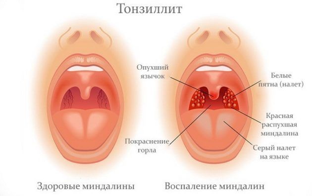 Тонзиллит
