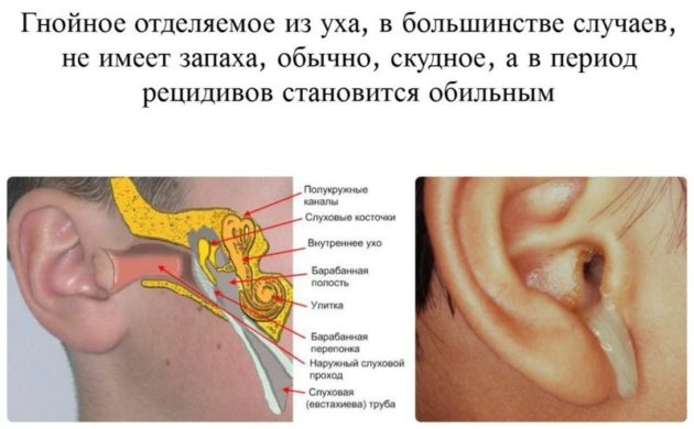 Средний отит острой формы
