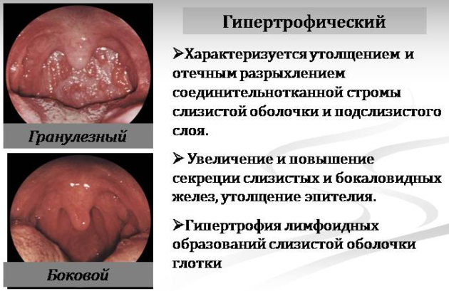 Гипертрофический ринит