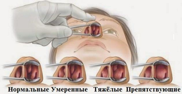 Какие бывают виды полипов в носу