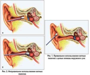 Пробка в ушах