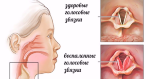 Голосовые связки при хроническом ларингите