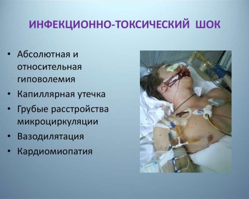 Инфекционно-токсический шок