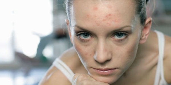 Особенности течения и методы лечения себорейного дерматита на лице