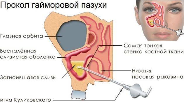 Прокол при гайморите