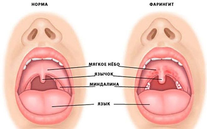 Отит среднего уха может возникнуть из-за фарингита 