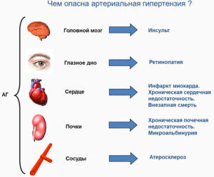 Артериальная гипертензия