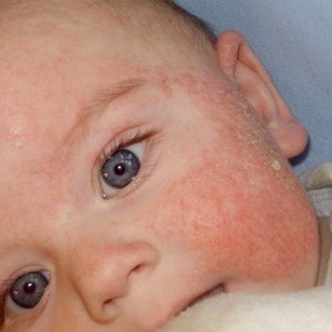 ?Наружные средства для лечения дерматита у детей