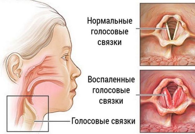 Существуют различные виды ринита, которые могут стать причиной возникновения серьезных осложнений