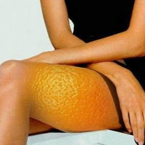 Как избавиться от целлюлита на бедрах и ягодицах
