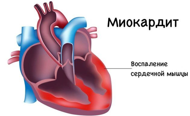 Миокардит