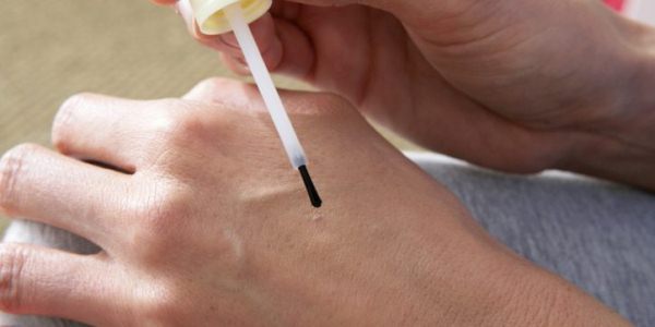 ✋Причины появления и методы лечения папиллом на руках