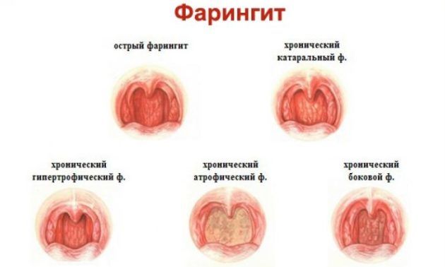 Виды фарингита