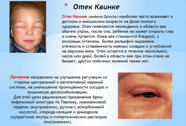 Отек квинке