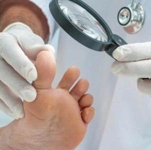 Профессиональные и домашние методы лечения сухой мозоли на пальце ноги