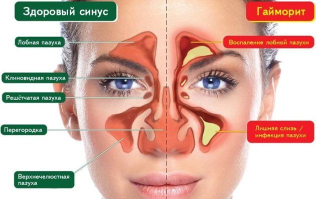 Причины развития гайморита
